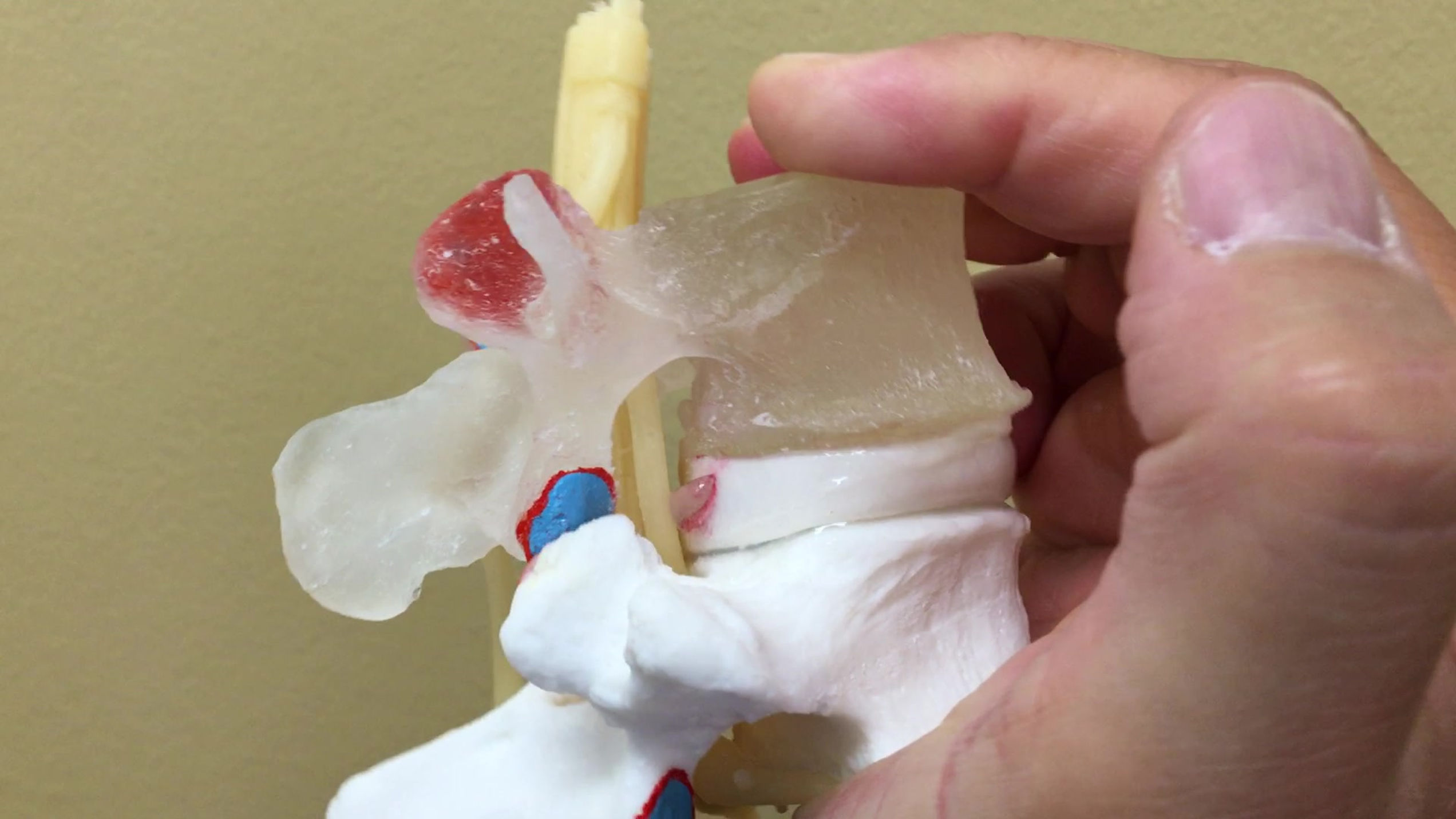 Bulging Lumbar Disc